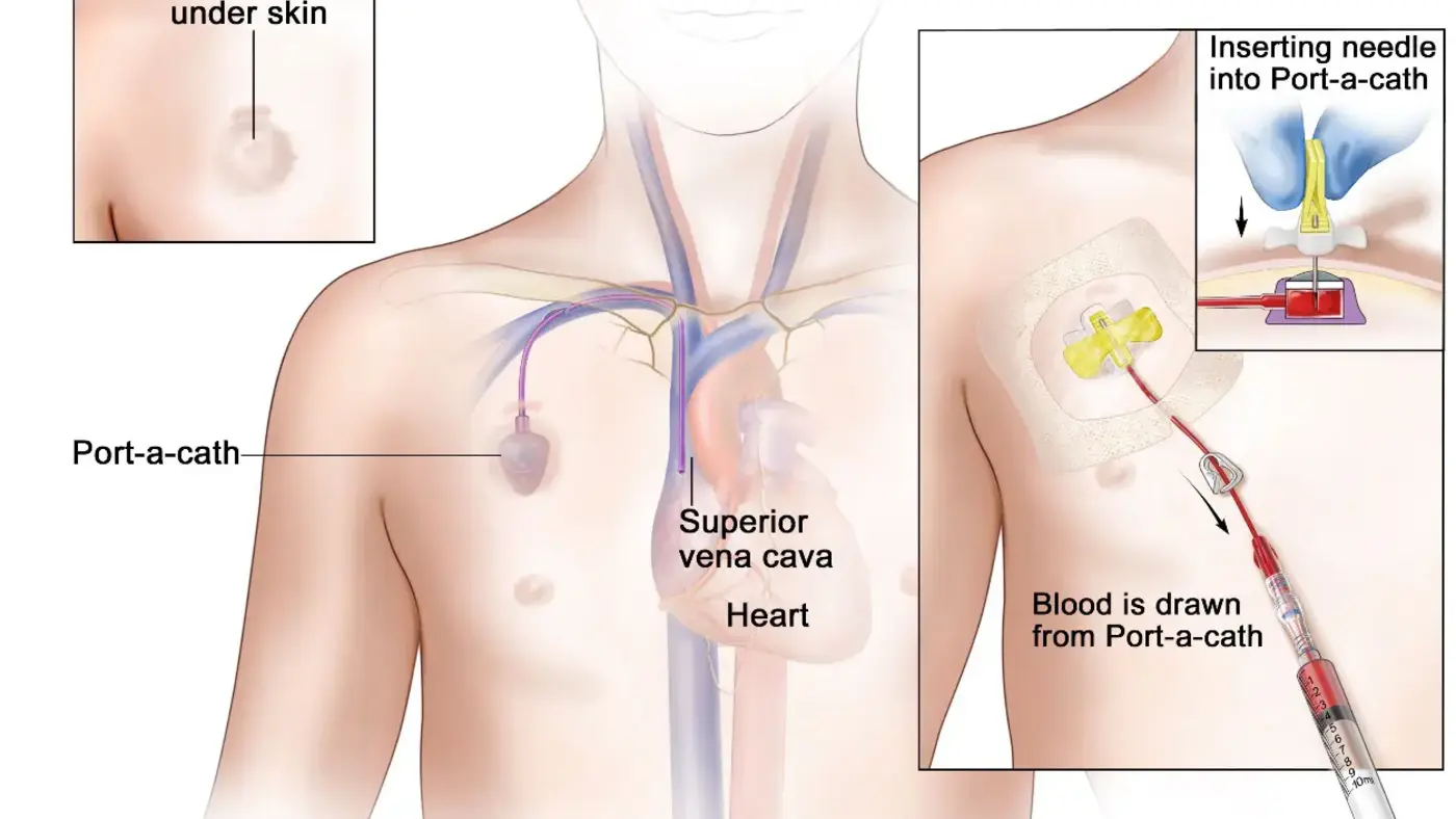 Port-a-Cath Device Flow Analysis